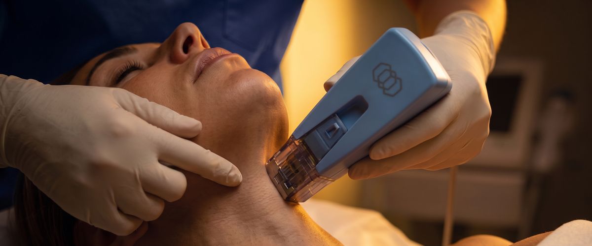 Tratamento com Morpheus8 para flacidez da pele, aplicado no pescoço de paciente na Clincer, São Paulo