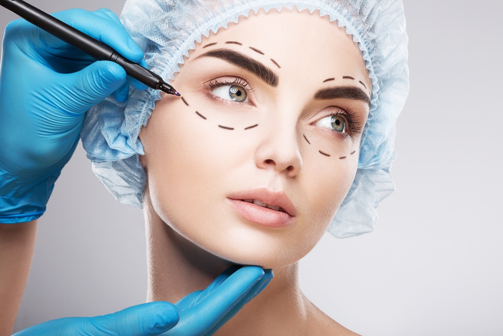 Marcações nos olhos da paciente antes de cirurgia plástica facial